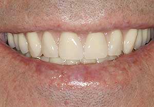 Smile Makeovers by Dr. David Richardson - Charleston South Carolina Dentist